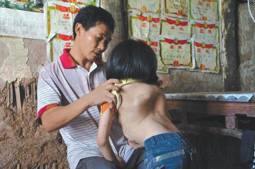 有嚴重脊椎畸形及胸腔隆突病的李文霞。