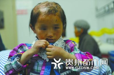 被燙傷的頭皮一直沒有愈合。