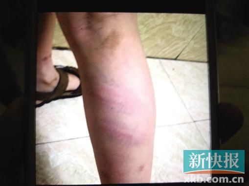 小宇腿部有明顯瘀痕。 翻拍自家屬手機