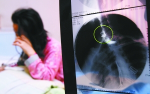 假牙上的鋼絲刺破食管，而薄薄的食道壁緊貼主動脈血管，極易造成血管破裂