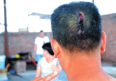 崔先生頭部受傷。京華時報記者趙思衡攝/視頻