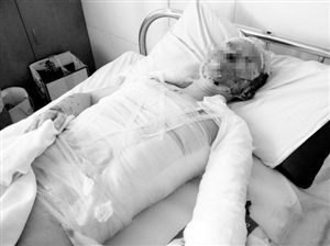 周小姐的頭、頸、軀干、四肢均被燒傷，其中面部燒傷最為嚴重。