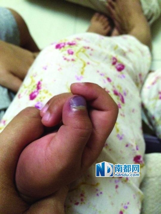 小逸手指被夾傷。