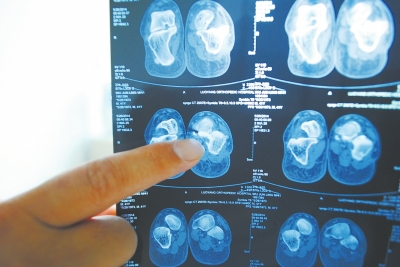 X光片顯示,確實(shí)有一根殘留的螺絲釘。