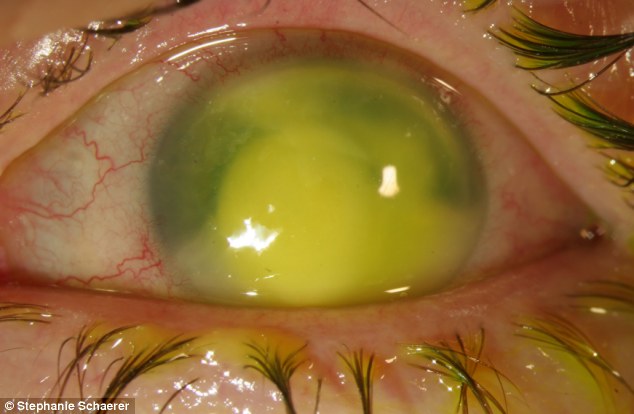 恐怖慎入！隱形眼鏡致英女子摘除眼球