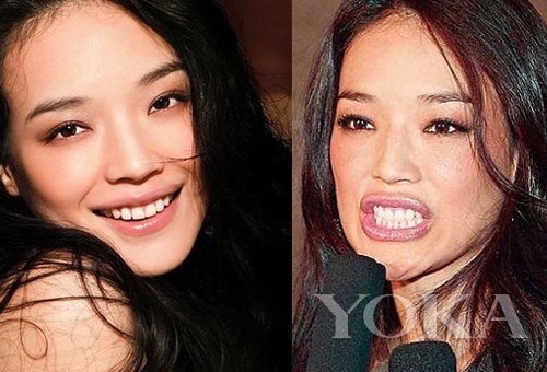 牙齒凸出，口輪肌過于松弛