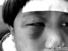 6月2日，網(wǎng)曝渭南市臨渭區(qū)一不滿5歲的女童遭奶奶毆打，眼圈青腫，引起網(wǎng)友關(guān)注，但孩子父母和爺爺均稱是摔倒導(dǎo)致。相關(guān)部門介入調(diào)查發(fā)現(xiàn)確為奶奶毆打所致，鑒于其身體原因已進(jìn)行批評教育。