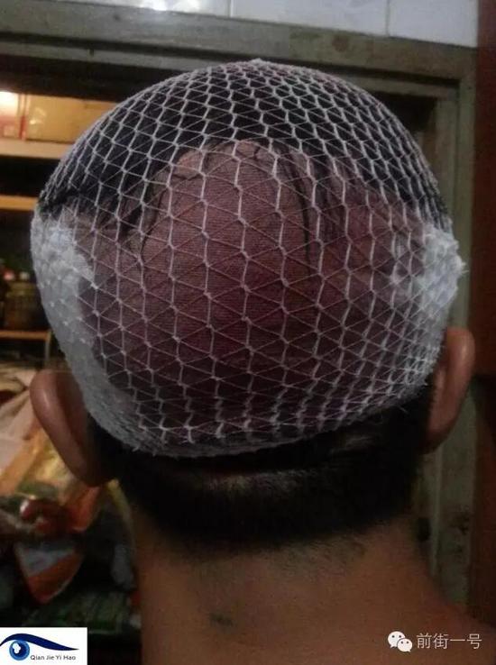 李律師受傷后縫合三針。