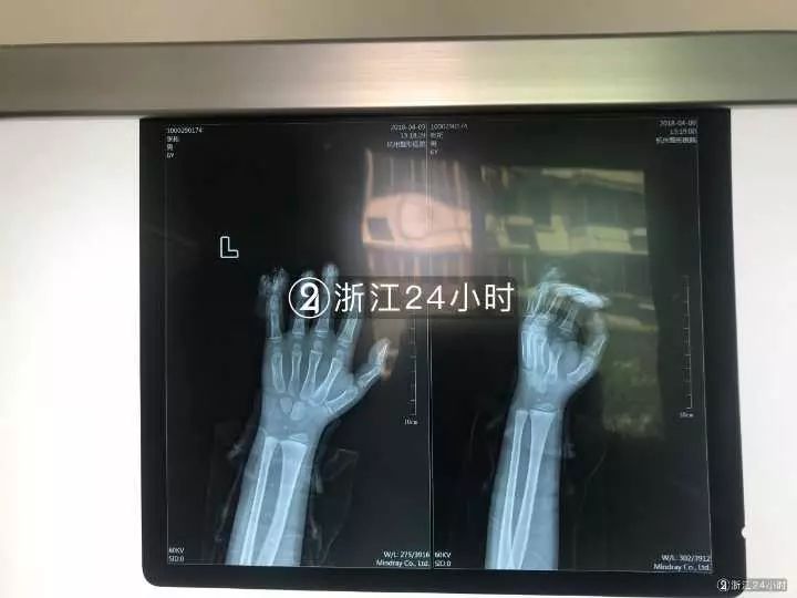 嚇哭！6歲男孩被夾斷手指 罪魁禍?zhǔn)拙故切７? oldsrc=