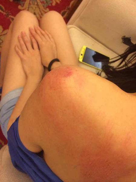 “跑男”真的很拼！baby朋友圈曬后背紅腫照