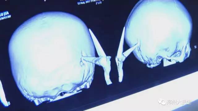 剪刀插入6歲女孩頭部 圖片讓人心驚膽戰(zhàn) 剪刀插入6歲女孩頭部 圖片讓人心驚膽戰(zhàn)