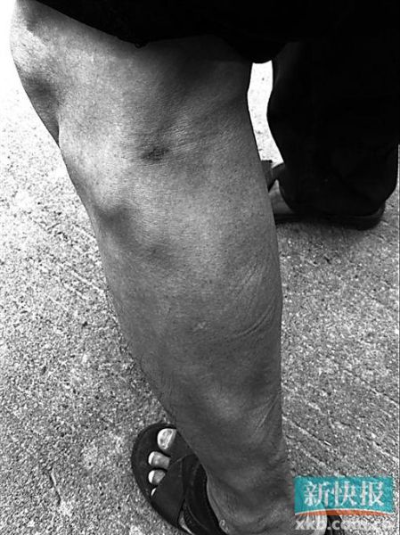 傷者身上遺留的彈痕。