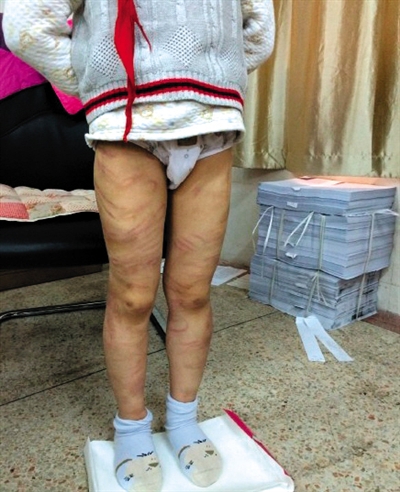 4月3日晚，微博網(wǎng)友“@朝廷半日閑”發(fā)圖文微博展示男童被虐待的慘狀。 微博截圖