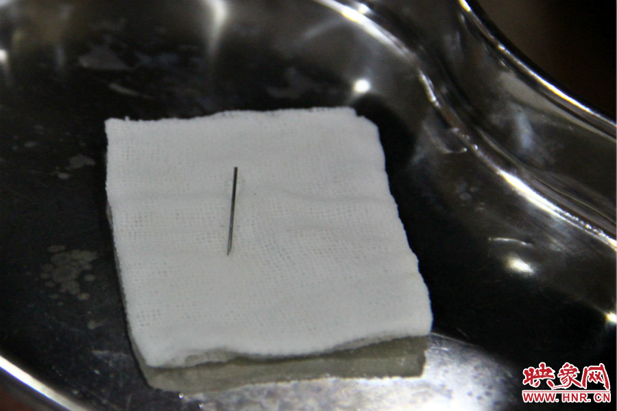 上午11點(diǎn)30分許，小龍腦中鋼針已經(jīng)成功取出。