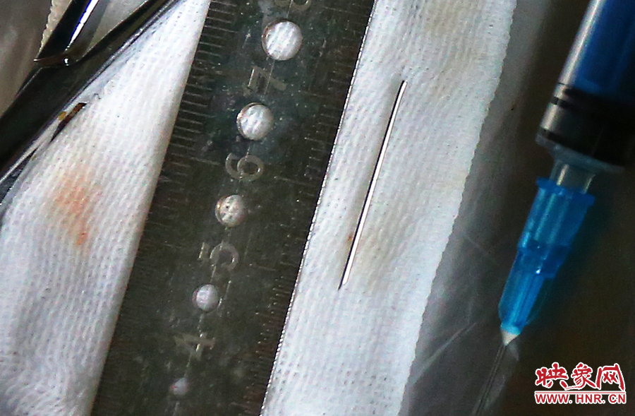 上午11點42分，大龍顱內(nèi)的鋼針被取出