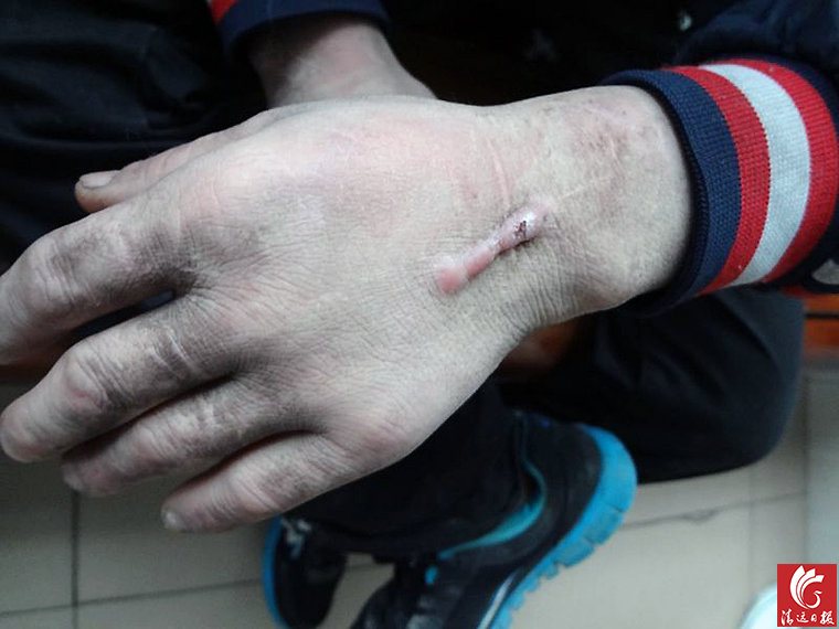被發(fā)現(xiàn)男子手上的傷疤。
