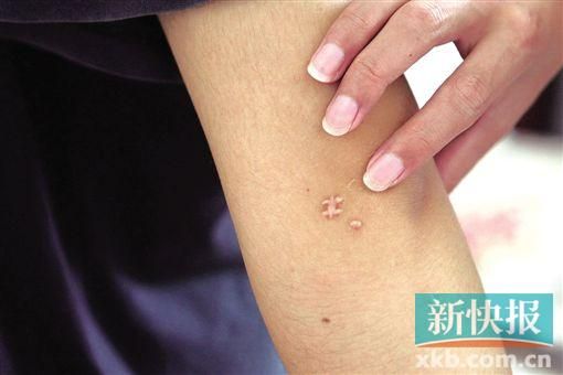 取出針后李星兒手臂留下了傷口。新快報記者 張國鋒/攝