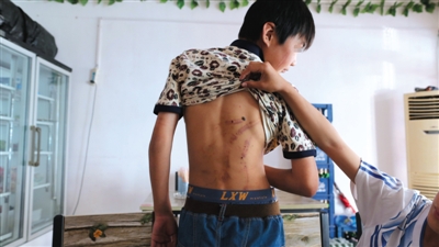 　昨日，奶西村，被打的小剛后背上條條瘀痕依然明顯。