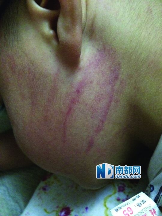 小逸臉上淤痕清晰可見。