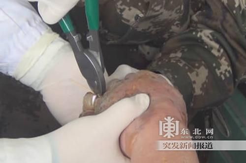 正在拆除戒指。