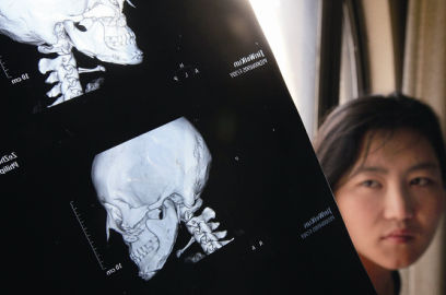 國內(nèi)醫(yī)院CT顯示，如今靳魏坤的鼻子假體是歪的，連下巴也是歪的