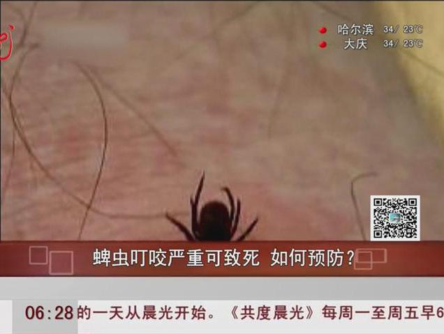 蜱蟲叮咬嚴(yán)重可致死如何預(yù)防？