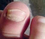 一幼兒園兒童“指甲異?！? title=